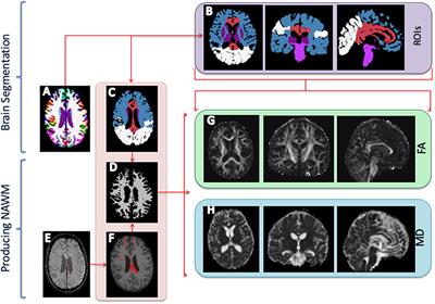 Two Coarse Spatial Patterns of Altered Brain Microstructure Predict Post-traumatic Amnesia in the Subacute Stage of Severe Traumatic Brain Injury